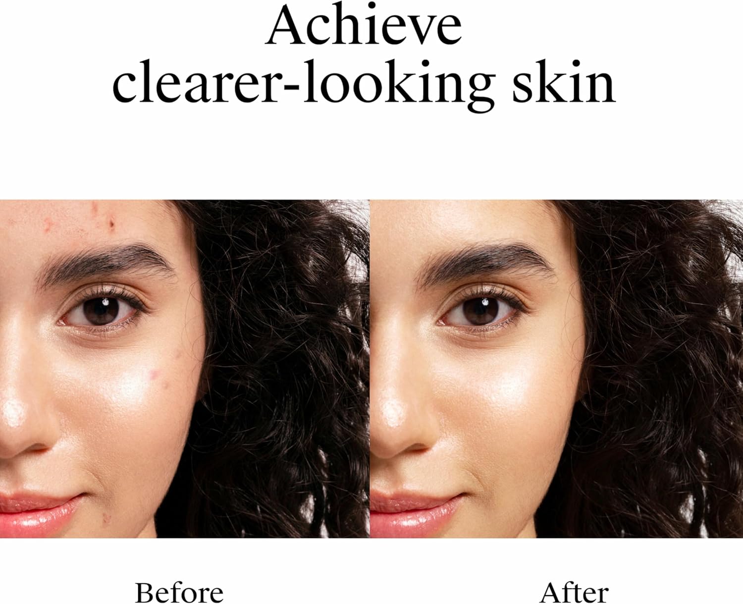 Neutrogena Rapid Clear Stubborn Acne Spot Treatment Gel, Maximum Strength 10% Benzoyl Per-oxide Treatment Medication for Acne Prone Skin, Pimple Cream Reduces Size & Redness, 1 oz - Image 3