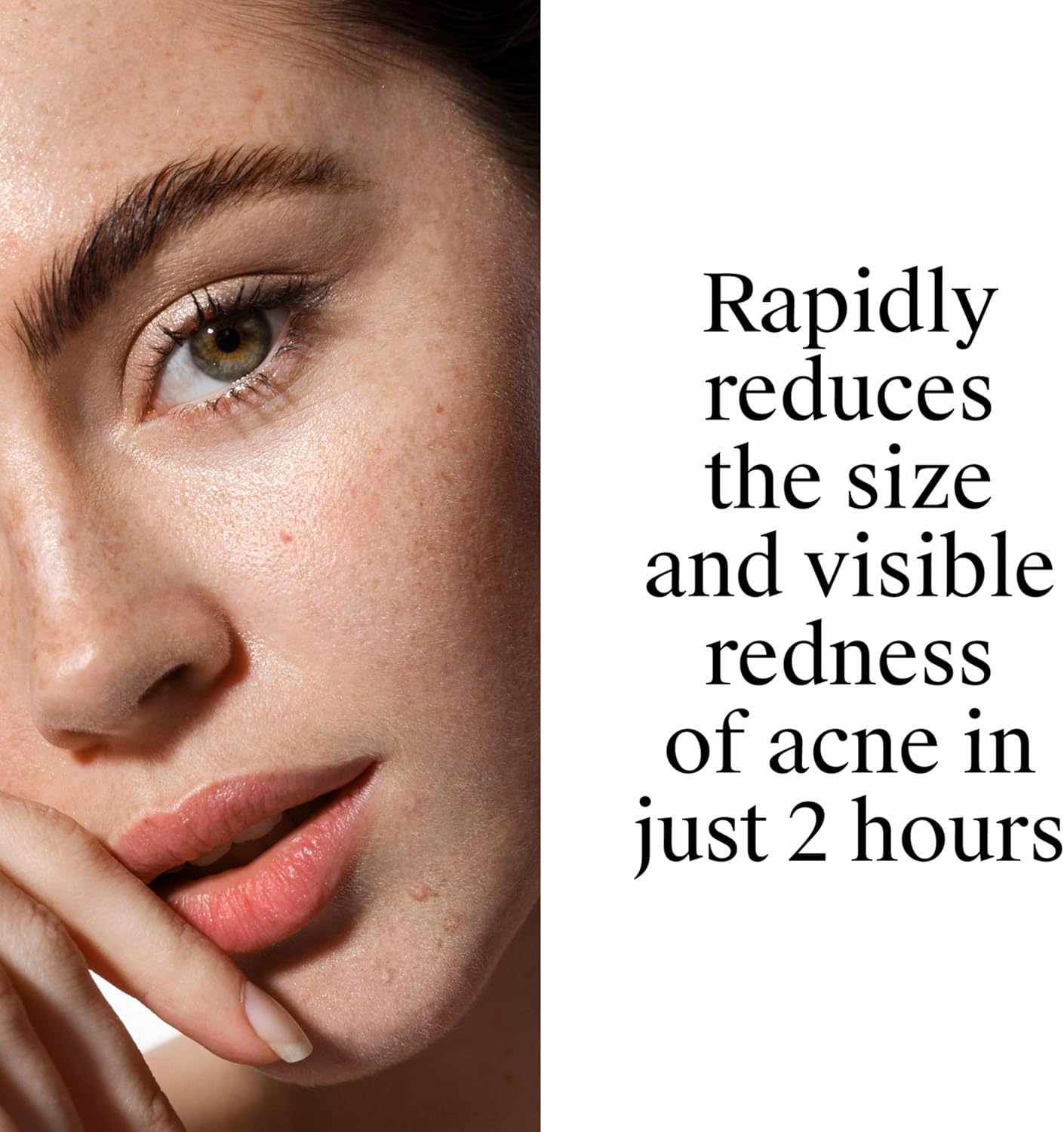 Neutrogena Rapid Clear Stubborn Acne Spot Treatment Gel, Maximum Strength 10% Benzoyl Per-oxide Treatment Medication for Acne Prone Skin, Pimple Cream Reduces Size & Redness, 1 oz - Image 6