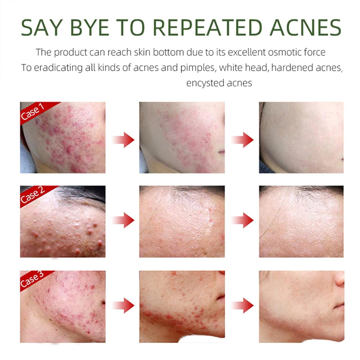 Acne Removing Face Cream,Natural Ingredients Professionally Remove Acne Marks,For Teens & Adults Anti-acne Moisturizer Pimple Cream - Image 5