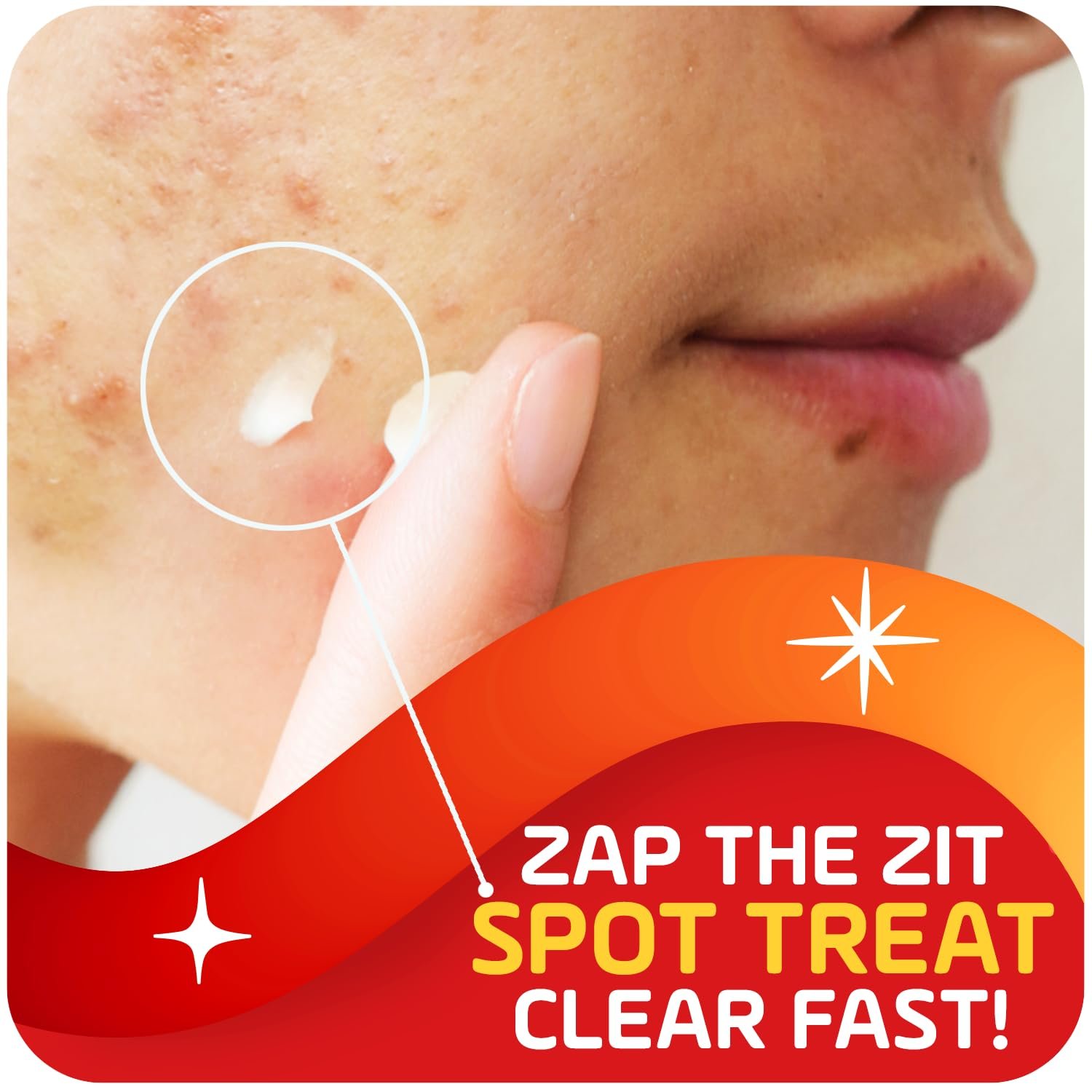 Asepxia 2% Salicylic Acid Acne Spot Treatment Cream | Drying Formula Targets Acne, Clears & Prevents Blemishes, Reduces Redness, Penetrates Pores, Pimple Cream, 1 Oz, 1-Pack - Image 2