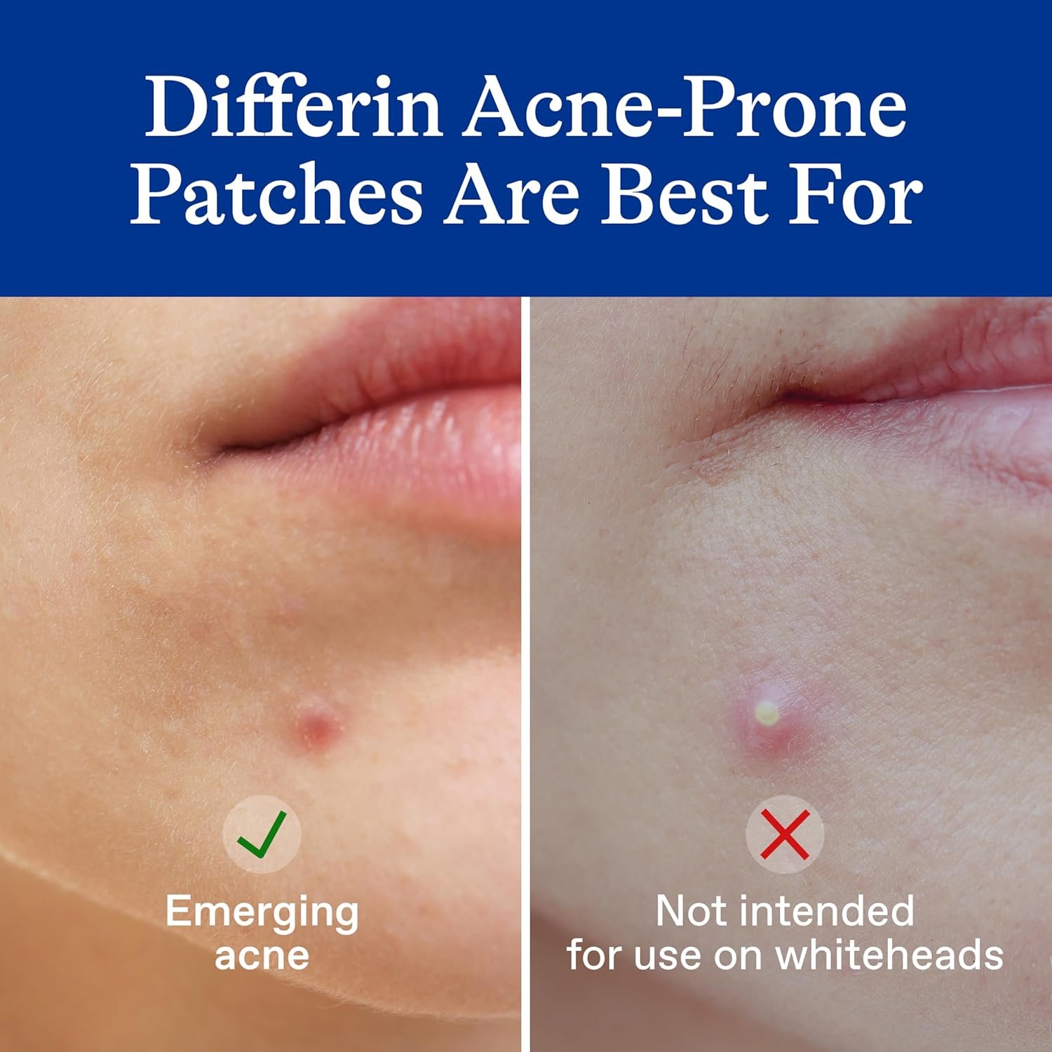 Differin Acne Patches, Pimple Patches for Acne Prone Skin, Formulated with Salicylic Acid and Centella, Fast Triple Action Power Patch for Day & Night, Dermatologist Tested, 36 Count - Image 3
