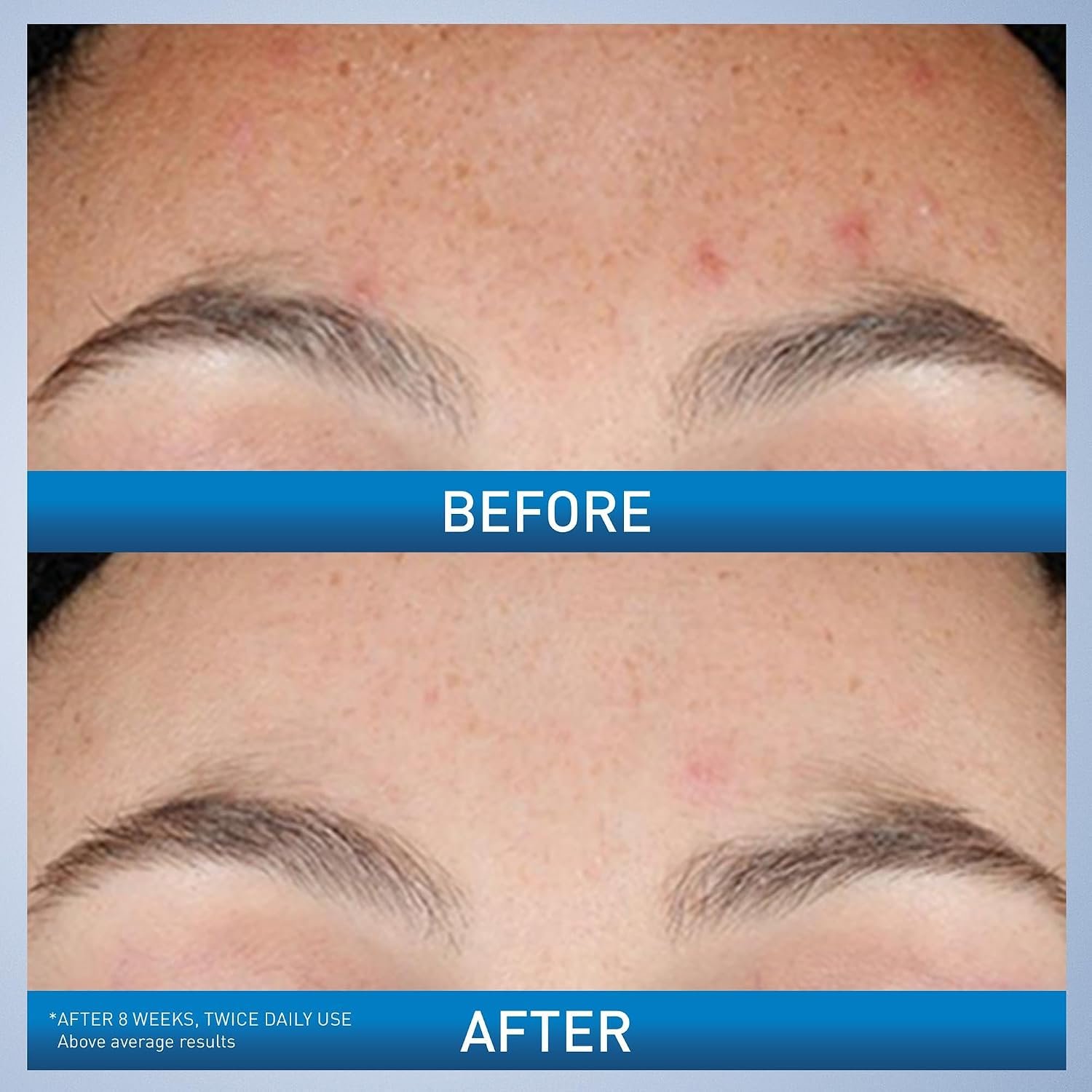CeraVe Resurfacing Retinol Serum For Post Acne Marks, Formulated With Licorice Root Extract & Niacinamide, Brightening Serum & Pore Minimizer For Face, Post Acne Skin Barrier Repair, Non-Comedogenic - Image 3