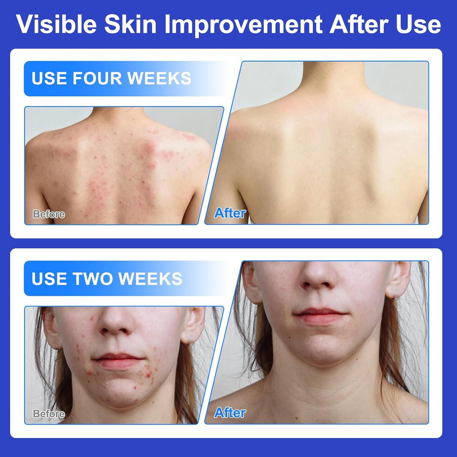 Acne Treatment for Face, Folliculitis Cream with 1% Salicylic Acid for Cystic – Multi-Purpose Gentle Herbal Formula for Scalp, Face & Body – Soothes Redness, Helps Prevent New Pimples, Fast Acting - Image 7