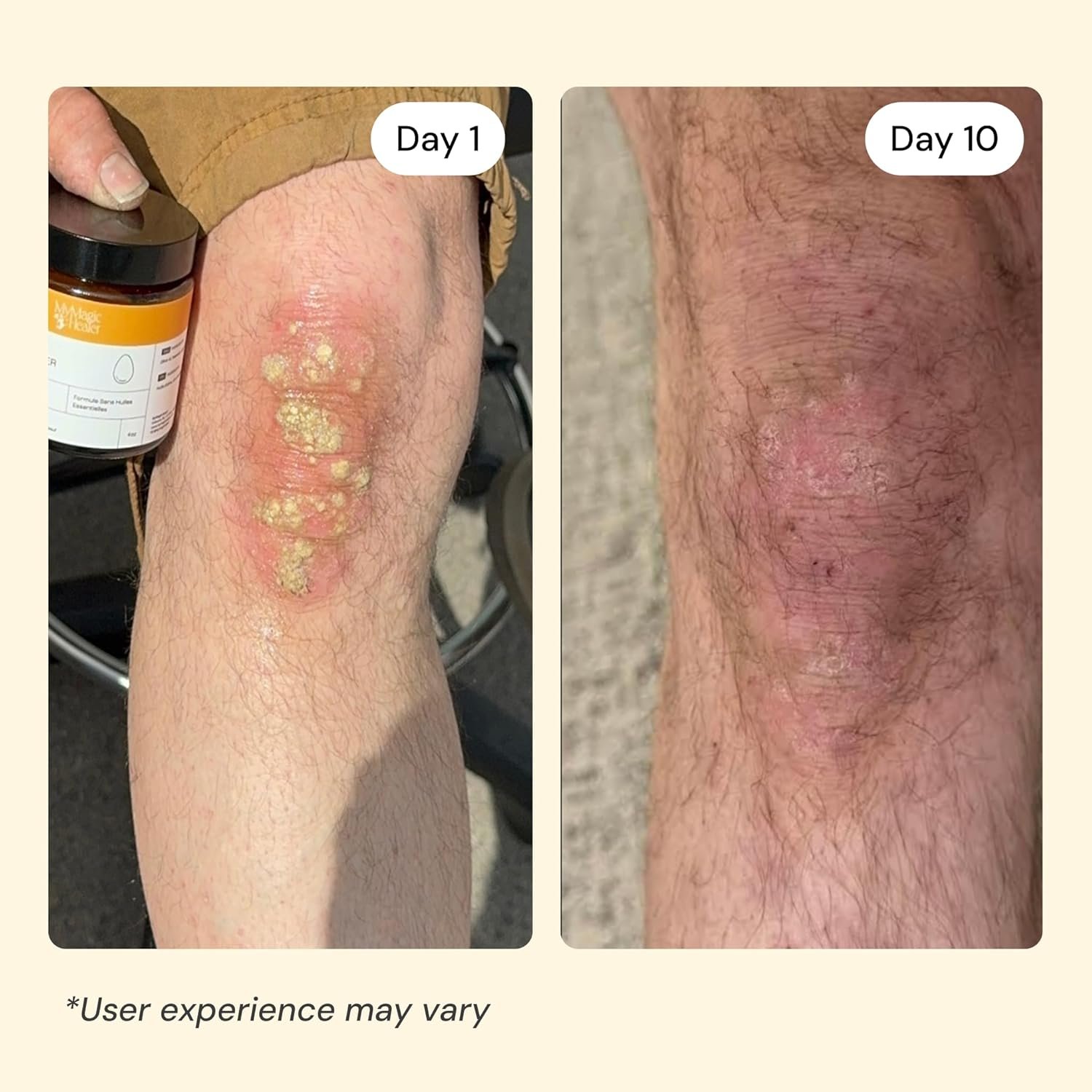 MyMagicHealer Universal Flare Care | Essential Oil Free | Baby Dermatitis, Diaper Rash, Eczema, Psoriasis, Impetigo | Wound Care | Multi-purpose Solution for Sensitive Skin w/ Propolis & Egg Yolk 4 oz - Image 4