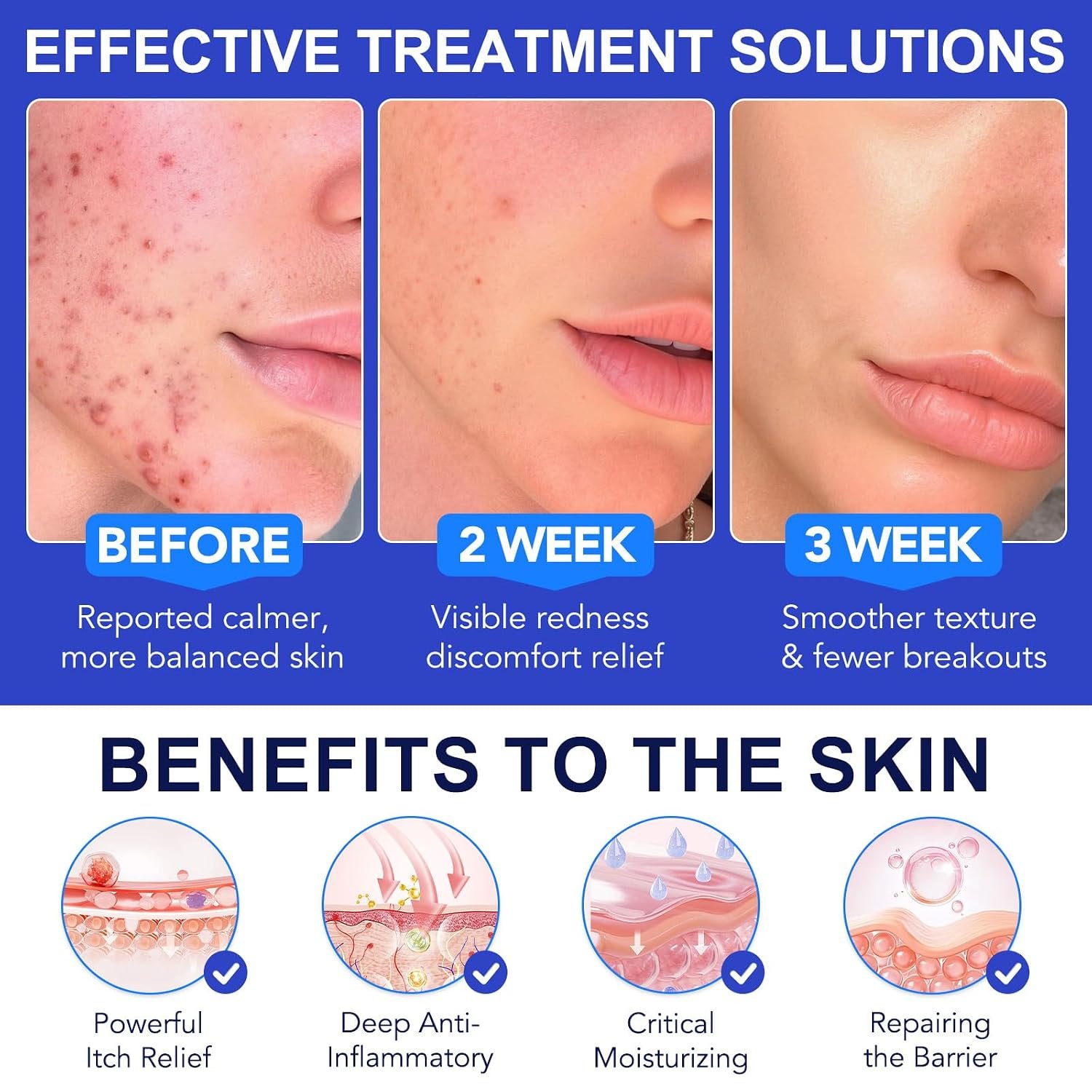 Acne Treatment for Face, Folliculitis Cream with 1% Salicylic Acid for Cystic – Multi-Purpose Gentle Herbal Formula for Scalp, Face & Body – Soothes Redness, Helps Prevent New Pimples, Fast Acting - Image 2