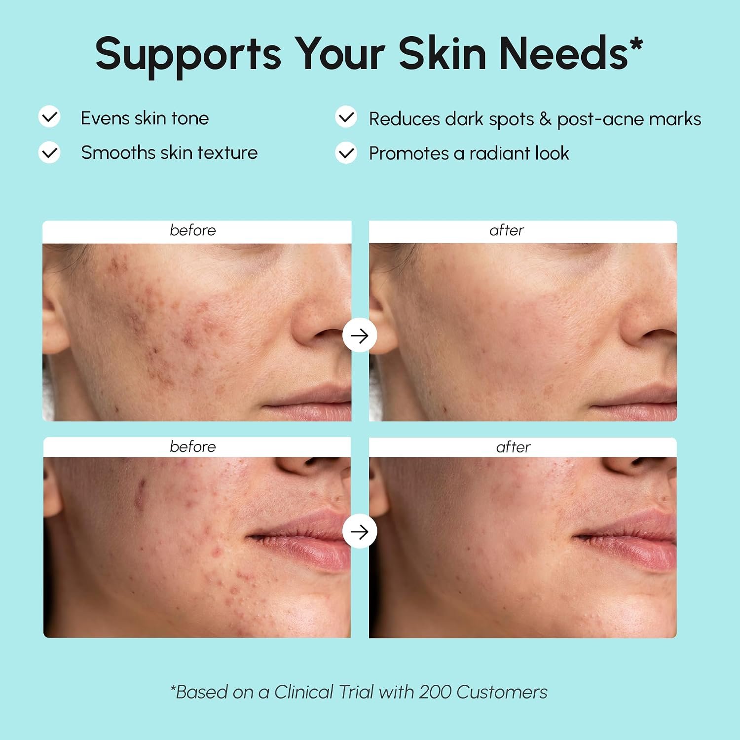 MAREE Azelaic Acid Face Cream – Azelaic Acid Treatment with Niacinamide & Salicylic Acid – Dark Spot Corrector for Face, Redness Relief, Smooth Even Skin Tone – Acido Azelaico for Acne Prone Skin - Image 3