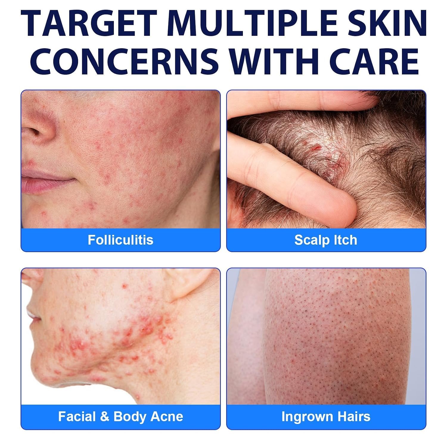 Acne Treatment for Face, Folliculitis Cream with 1% Salicylic Acid for Cystic – Multi-Purpose Gentle Herbal Formula for Scalp, Face & Body – Soothes Redness, Helps Prevent New Pimples, Fast Acting - Image 6
