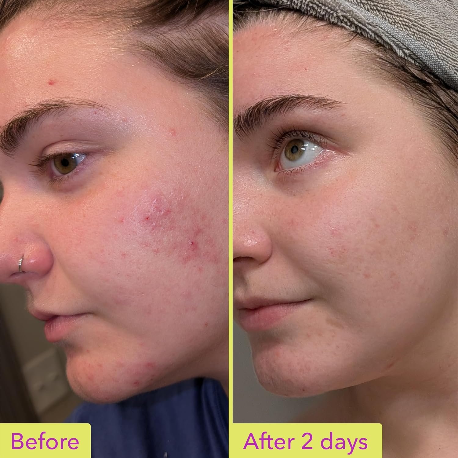 Good Molecules 10% Azelaic Acid Treatment for Face – Blurs Facial Redness & Evens Skin Tone – Brightens the Look of Dark Spots & Refines Texture – Vegan & Fragrance-Free Skincare (30ml / 1.01 fl oz.) - Image 3